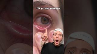 POV you might have anemia💗 follow for more😱 skincare skincareroutine skin beauty [upl. by Halona218]