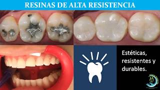 Resinas dentales de alta resistencia [upl. by Enelym]