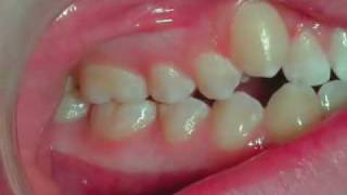 Invisalign Treatment Snaggle Tooth Correction [upl. by Der]