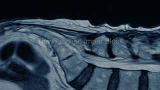 PainExam US Guided Ganglion Impar Block Coccygodynia Pelvic amp Perineal Pain David Rosenblum MD [upl. by Carmela]