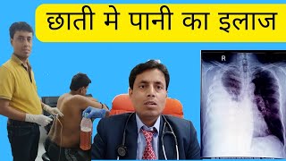 Pleural effusion treatment ll छाती मे पानी का इलाज ll Chest Specialist in patna ll Dr Sanjay kumar [upl. by Myo]