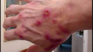 The Morgellons Lesion [upl. by Edea]