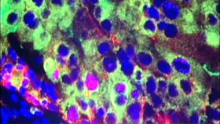 Nanoparticles for Cancer Treatment Video  Brigham and Womens Hospital [upl. by Westley526]