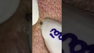 Blackheads Removal  Acne Treatment and Very Satisfying Satisfying Pimple pop blackheads [upl. by Nosreffej894]