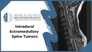 Intradural Extramedullary Spine Tumors [upl. by O'Toole550]