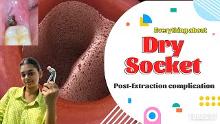 Everything about DRY SOCKET  post operative complication of extraction  causes  prevention [upl. by Karas]