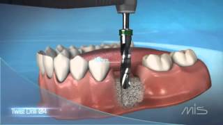 Procedimiento de colocación de implante dental MIS El Salvador [upl. by Imak606]