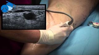 Marking of Small Saphenous Vein SSV and Incompetent Perforating Vein IPV [upl. by Mundford]