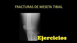 Fractura de Meseta Tibial  Ejercicios que puedes hacer en casa [upl. by Possing]