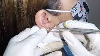 How to Remove an Earring Stuck in Womans Earlobe [upl. by Assena851]