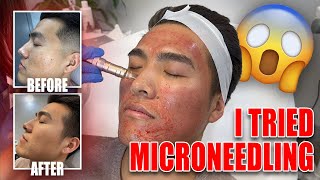 Before and After 3 Microneedling Sessions [upl. by Kegan]