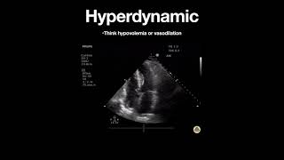 Hyperdynamic Left Ventricle Apical [upl. by Neda314]