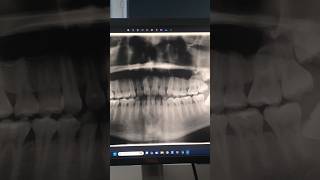 Teeth x ray [upl. by Nomyt]