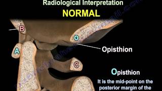 Occipitocervical Dislocation  Everything You Need To Know  Dr Nabil Ebraheim [upl. by Bunny]