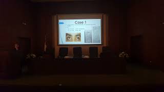 Exotropia case presentation Dr Yara Fathi [upl. by Rikki]