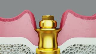 Nobel Biocare Updated Multi Unit Abutments [upl. by Krein]