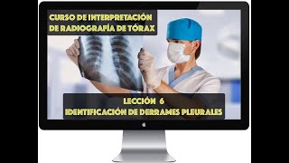 CURSO INTERPRETACIÓN RADIOGRAFÍA DE TÓRAX IDENTIFICACIÓN DERRAMES PLEURALES [upl. by Akinas]