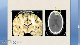 Pathology 899 a Meningioma Tumor IntraCranial Merlin NeuroFibromatosis Arachnoid Meninges [upl. by Mccurdy]