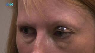 Fitting and using External Eyelid Weights in facial nerve palsy [upl. by Ocire]