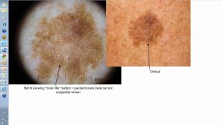 Dermoscopy Made Simple  Seborrhoeic Keratoses [upl. by Ayikaz]