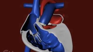 The Structure of a Heart with Hypoplastic Left Heart Syndrome HLHS  CHOP [upl. by Shayna]