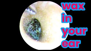 asmr ear cleaning  wax in your ear  Ear health  ear piercing cleaning how to unclog your ear [upl. by Alliscirp]