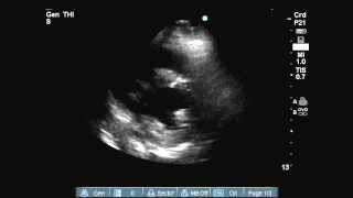 Regional Wall Motion Abnormality on Echo PSAX view Anterior amp Septal hypokinesis [upl. by Bryna321]