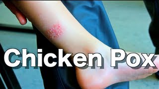 Chicken Pox VaricellaZoster Ask Your Pediatrician [upl. by Eilyak]