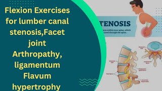 Flexion Exercises For lumber Canal stenosisFacet Joint Arthropathy ligamentum Flavum Hypertrophy [upl. by Rifkin]