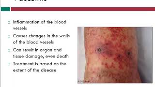 Vasculitis  Info About Vein Problems  WoundEducatorscom [upl. by Lateh359]