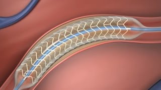 Absorbable Stent [upl. by Nitsirhc657]