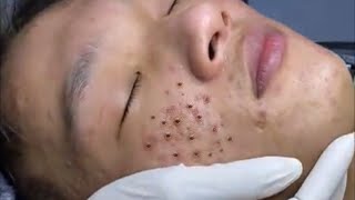 Loan Nguyen Acne Treatment 1704 [upl. by Farrington]