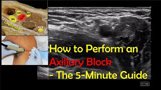 Axillary Block – A quotHowToquot Guide [upl. by Bryan]