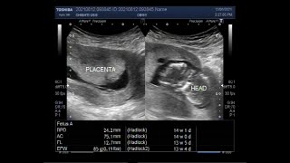 Missed Abortion with a Pregnancy of about 14 weeks [upl. by Viva]