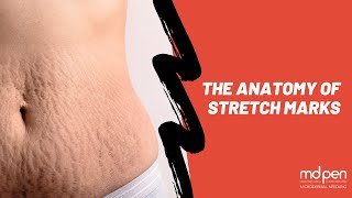 The Anatomy of Stretch Marks [upl. by Annayr]