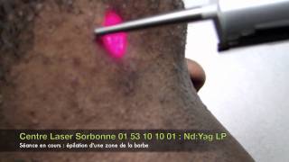 Epilation laser Paris phototype foncé LaserSorbonne [upl. by Ytok]