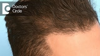 Do Finasteride have any side effects  Dr K Prapanna Arya [upl. by Einolem143]