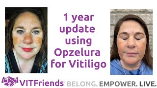 1 year using Opzelura for Vitiligo and a new development [upl. by Avivah]