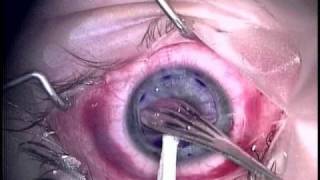 Corneal Transplant 1 [upl. by Lytton882]