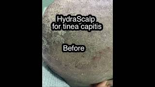 HydraScalp for tinea capitisseborrheic dermatitis [upl. by Sakiv911]