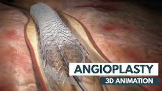 Angioplasty  3D Animation  Real Footage [upl. by Notyard]