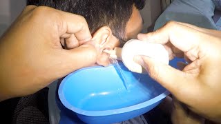 Removing Earwax Debris from Mans Ear [upl. by Shepp43]