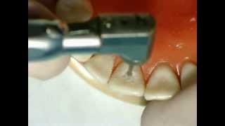 Palatal pit cavity preparation for amalgam  GV Black  Dr Ahmed Sleibi [upl. by Wilhelmine]