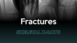 Fractures Skeletal XRays [upl. by Siclari303]