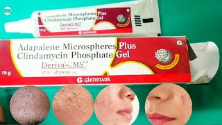 Deriva cms gel review  adapalene gel for Blackheads whiteheads acne  pimplesdarkspots पिंपल [upl. by Perretta201]