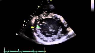 Normal echo  right parasternal short axis view at the level of the mitral valve [upl. by Namsu]