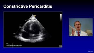 Treatment of Complicated Pericarditis [upl. by Kabob]