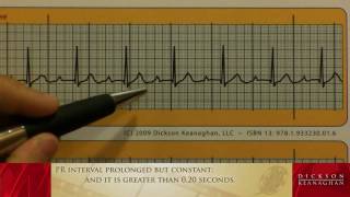 EKG Training An Introduction to Bradycardia  Heart Blocks Part 1 of 3 [upl. by Valene]