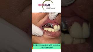 Teeth Implants for front teeth Smile Makeover smile dentalimplants [upl. by Aidnic147]