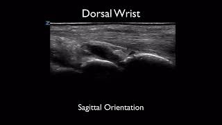 Ultrasound Guided Wrist Arthrocentesis Procedure [upl. by Yevrah516]